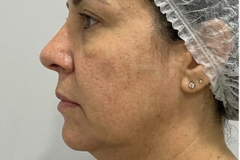Antes - Lifting Facial