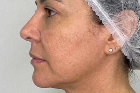 Depois - Lifting Facial